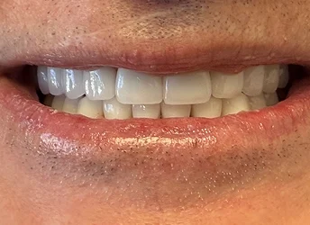 After cosmetic dentistry with brighter, straighter teeth