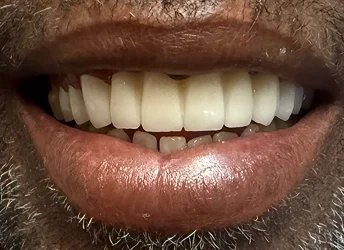 After full mouth restoration with a natural-looking smile
