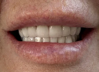 After smile makeover with healthy white teeth