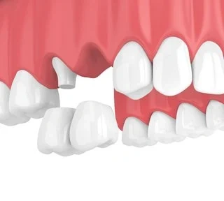 3D illustration of a cantilever dental bridge anchored to a single neighboring tooth.
