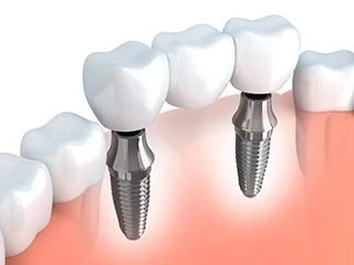 3D illustration of an implant-supported dental bridge with two titanium implant posts.