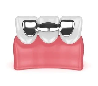 3D illustration of a Maryland bridge with metal wings bonded to the back of adjacent teeth.