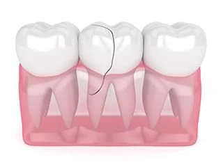 3D Representation of Broken or Cracked Teeth