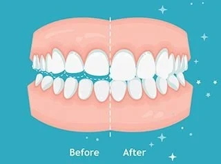 Bruxism Before after Image