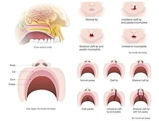 Diagrams of Cleft Lip