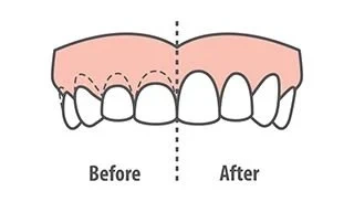 Crown Lightening Before after Graphical representation