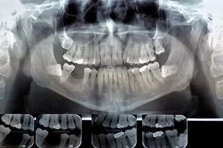 Digital Xray of Teeth