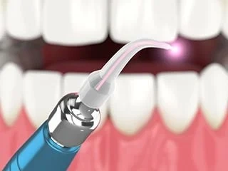 Diode laser used in dental treatment graphical image