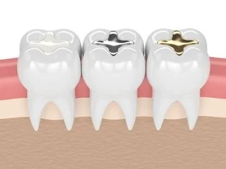 Dental Filling 3D Graphical Representation