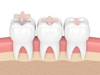 3D representation of inlays