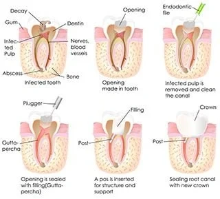 Root Canal Therapy Graphical Representation
