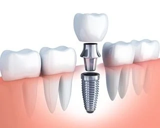 3D Representation of Single Dental Implants