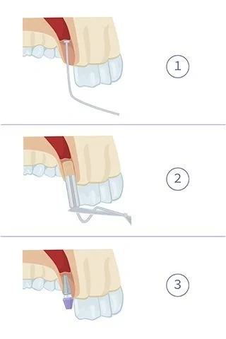 3 Step Diagram of Sinus Surgery