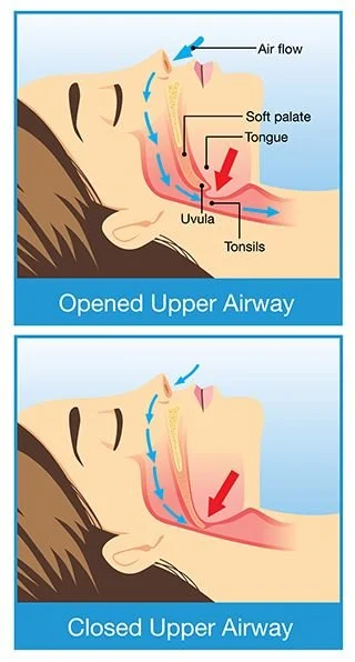 Graphical Representattion for snoring and sleep apnea