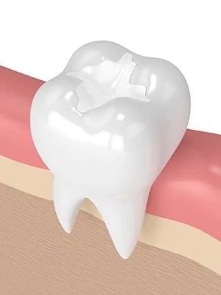 3D Graphics for tooth colored filling