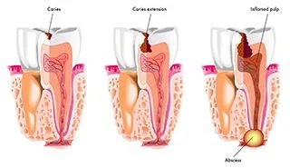 Graphical Demonstration of tooth decay