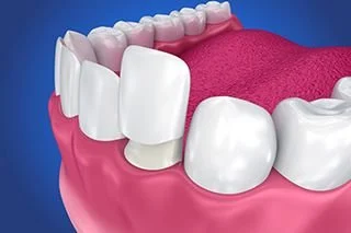 3D representation for dental veeners