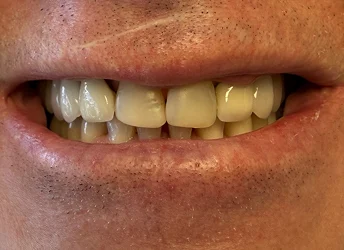 Before cosmetic dental treatment for stained and uneven teeth