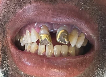 Before full mouth restoration with damaged and broken teeth
