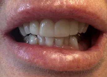 Before smile makeover with worn and discolored teeth
