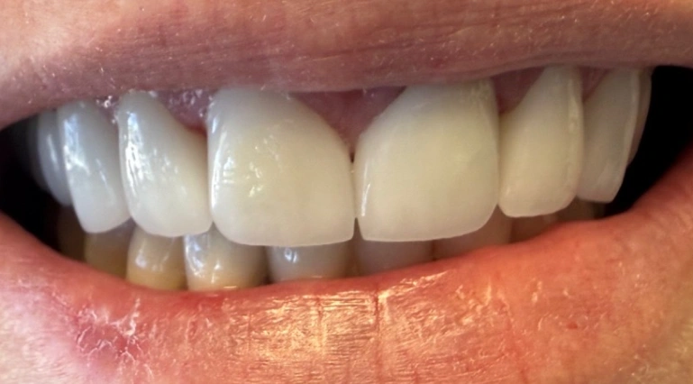 Close-up of upper front teeth after ceramic cosmetic crown treatment, showing bright white, evenly shaped teeth with natural translucency