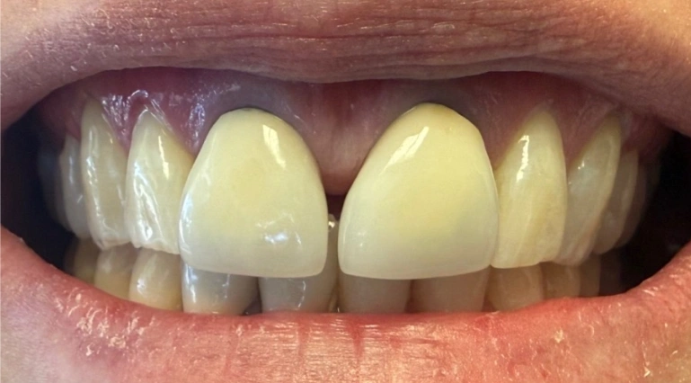 Close-up of upper front teeth before ceramic cosmetic crown treatment, showing discolored and unevenly shaped natural teeth