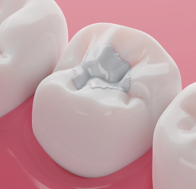 Close-up 3D illustration of a molar with a tooth-colored composite filling in the chewing surface