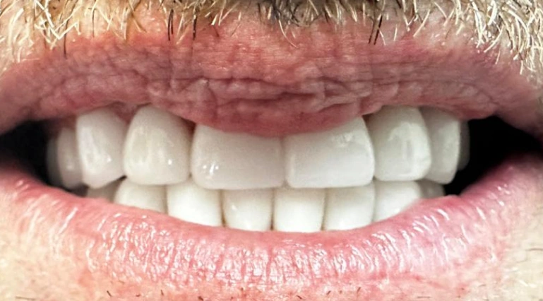 cosmetic dentistry discolored gapped front teeth after