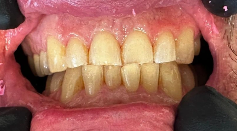 cosmetic dentistry discolored gapped front teeth before