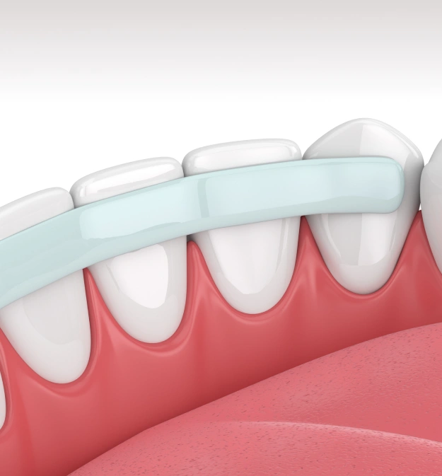 3D illustration of dental bonding material being applied to the front surface of lower teeth to repair chips or gaps