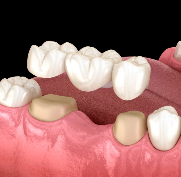 3D illustration of a dental bridge with three connected crowns positioned above the gap between two supporting teeth