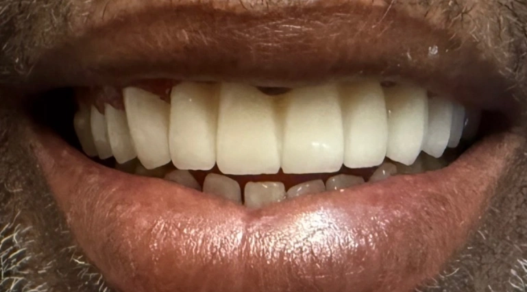 After dental crown restoration with a complete, natural-looking smile and restored front teeth.