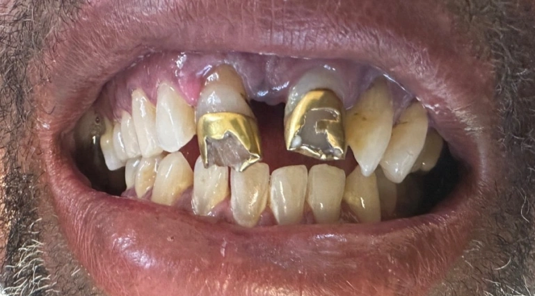Before dental crown restoration showing damaged front teeth, missing teeth, and worn dental crowns.