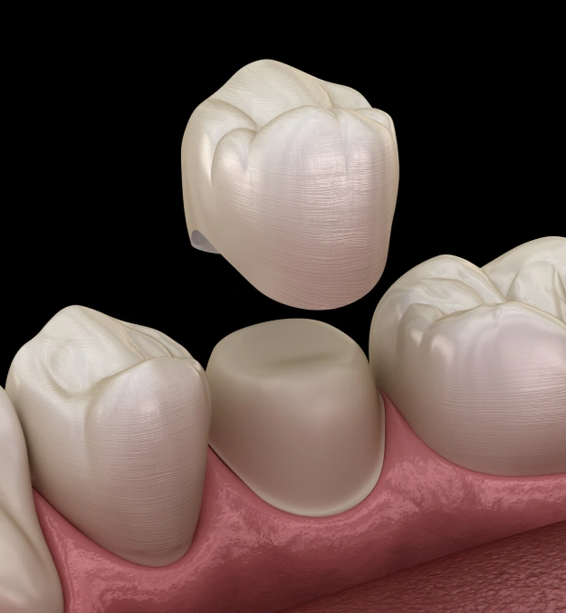 3D illustration of a single dental crown positioned above a prepared tooth, ready for placement between adjacent teeth