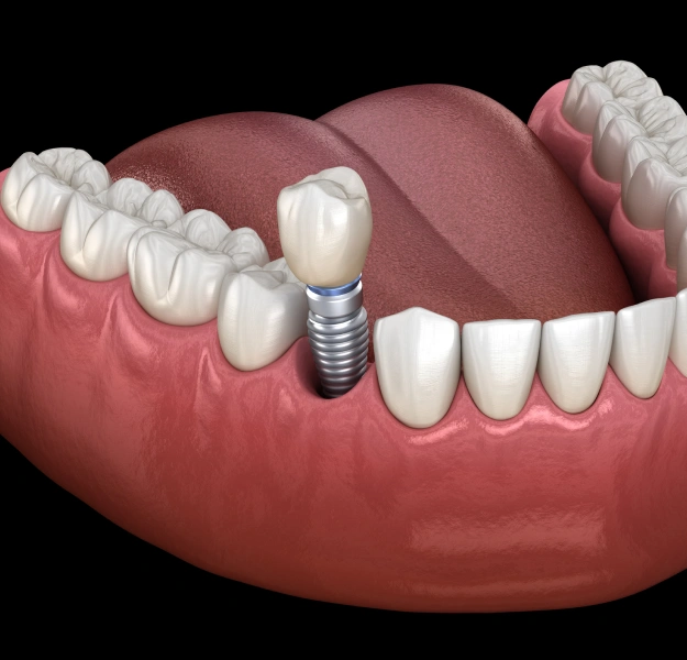 3D illustration of a dental implant showing the titanium post, abutment, and crown replacing a single missing tooth in the lower jaw