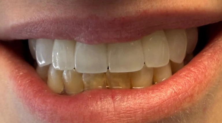 smile makeover white straight teeth after