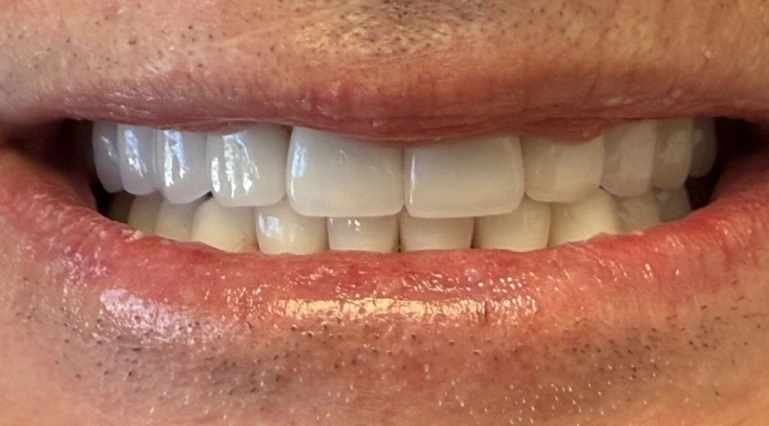 After dental restoration with aligned, bright, and natural-looking teeth.