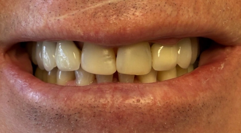 Before dental restoration showing worn, stained, and chipped front teeth.