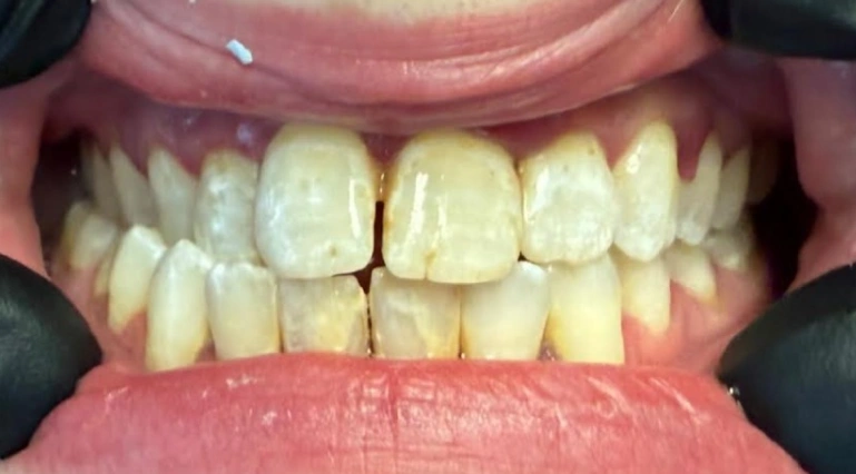 smile makeover white straight teeth before