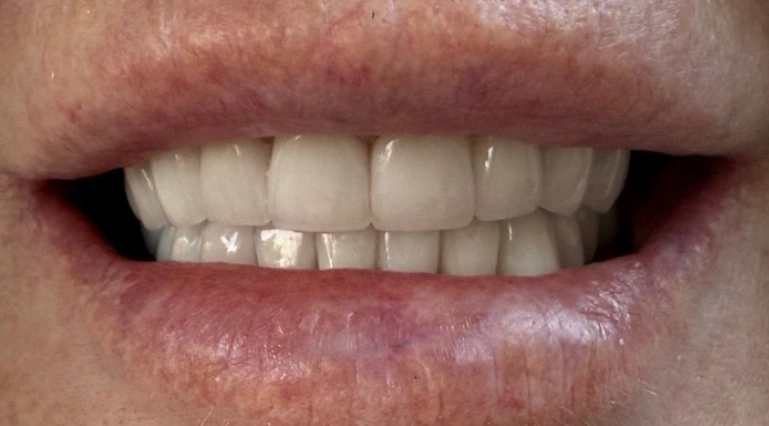 After tooth crown restoration with a healthy, natural-looking smile.