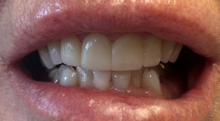 Before tooth crown restoration showing damaged and uneven front teeth.
