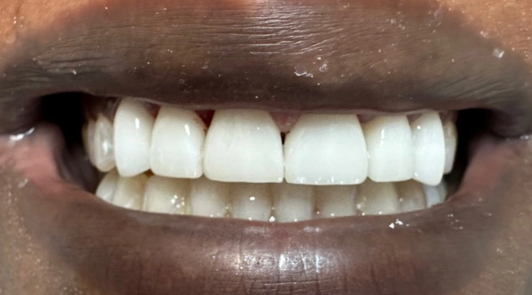 Veneers severely worn discolored teeth after