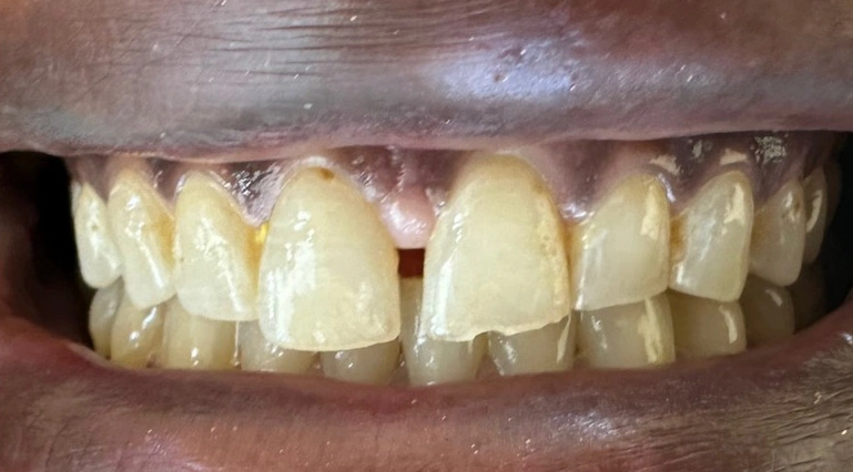 veneers severely worn discolored teeth before