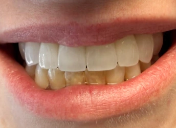 smile makeover white straight teeth after