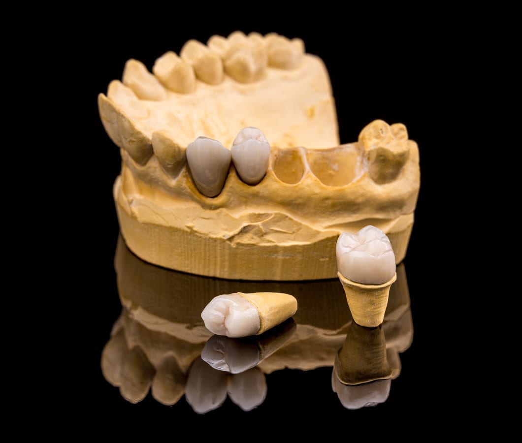 Dental Crowns in Sandalfoot Cove